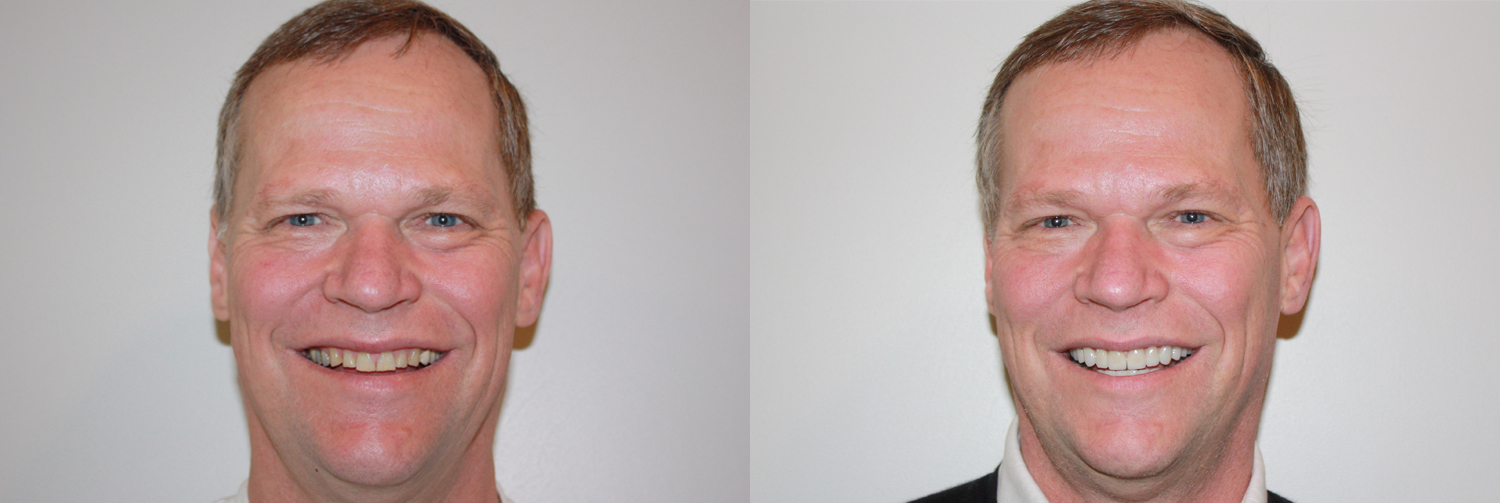 Full face_Hillis