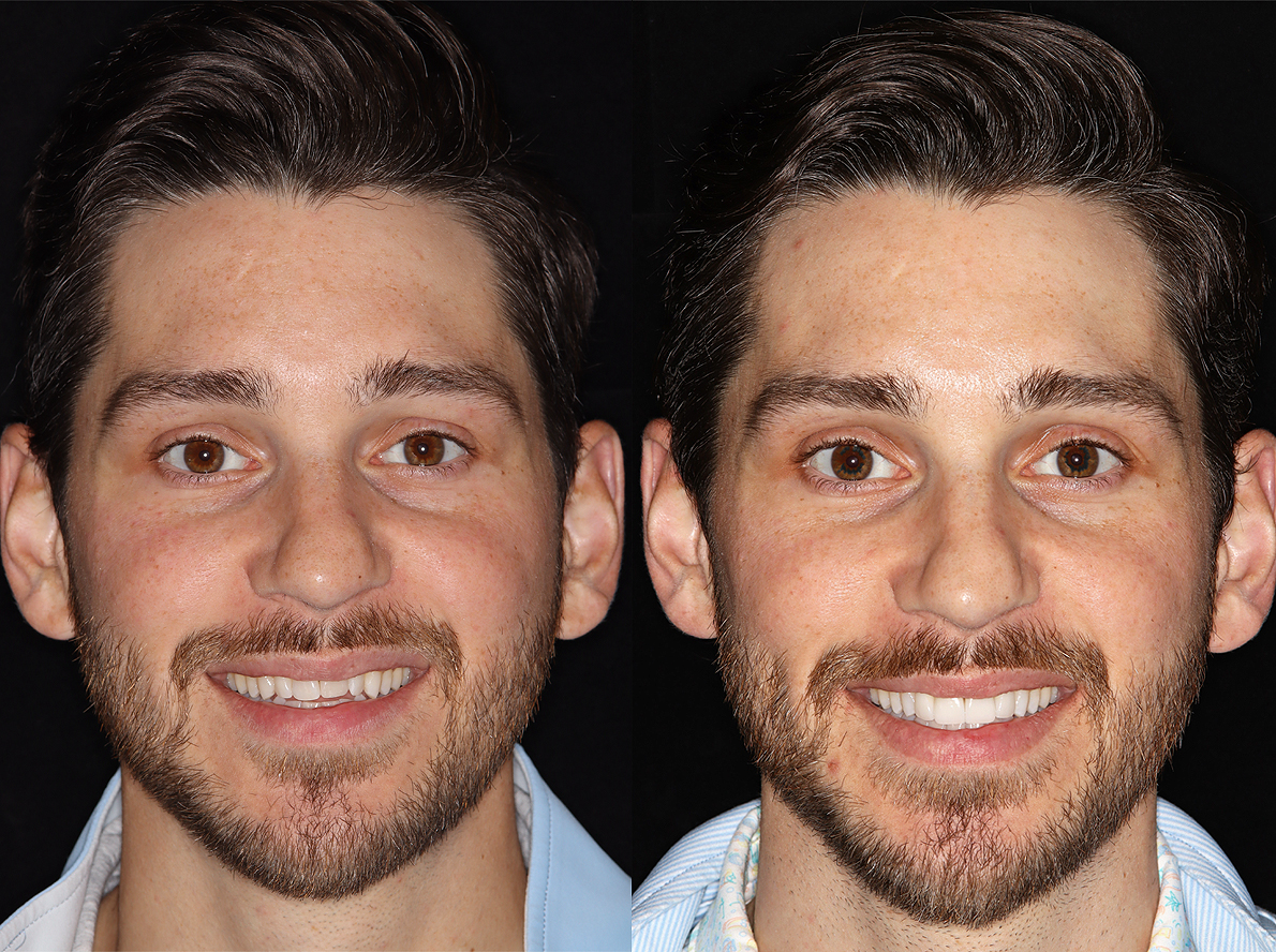 Full face_Hopkins