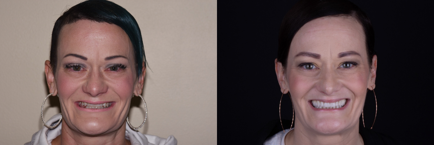 Full face_Lewis