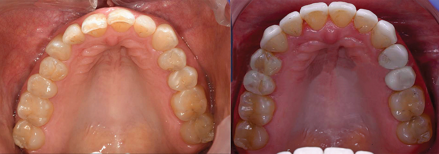 Occlusal_Abouzeid (3)