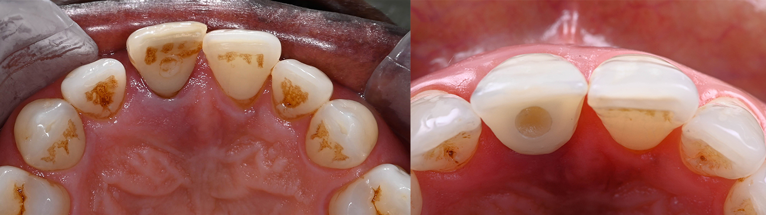 Occlusal_Abouzeid (5)