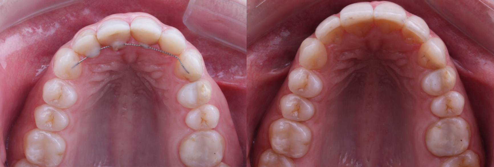 Occlusal_Alvarado