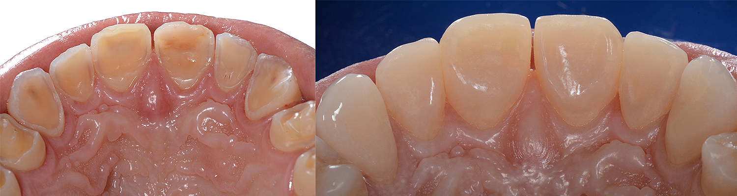 Occlusal_Ammannato