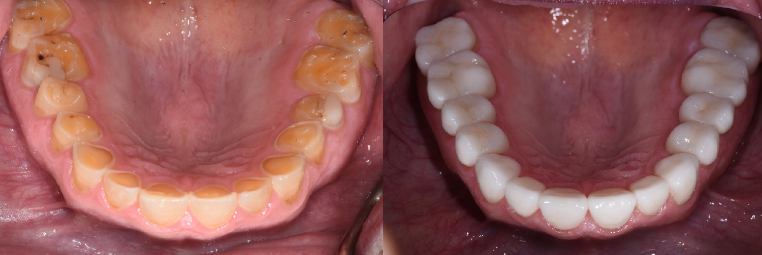 Occlusal_Avondoglio