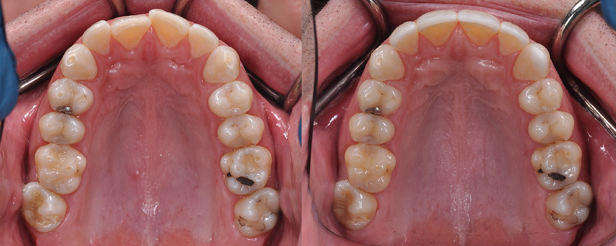 Occlusal_Bylis