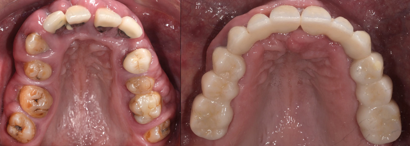 Occlusal_Elsayed