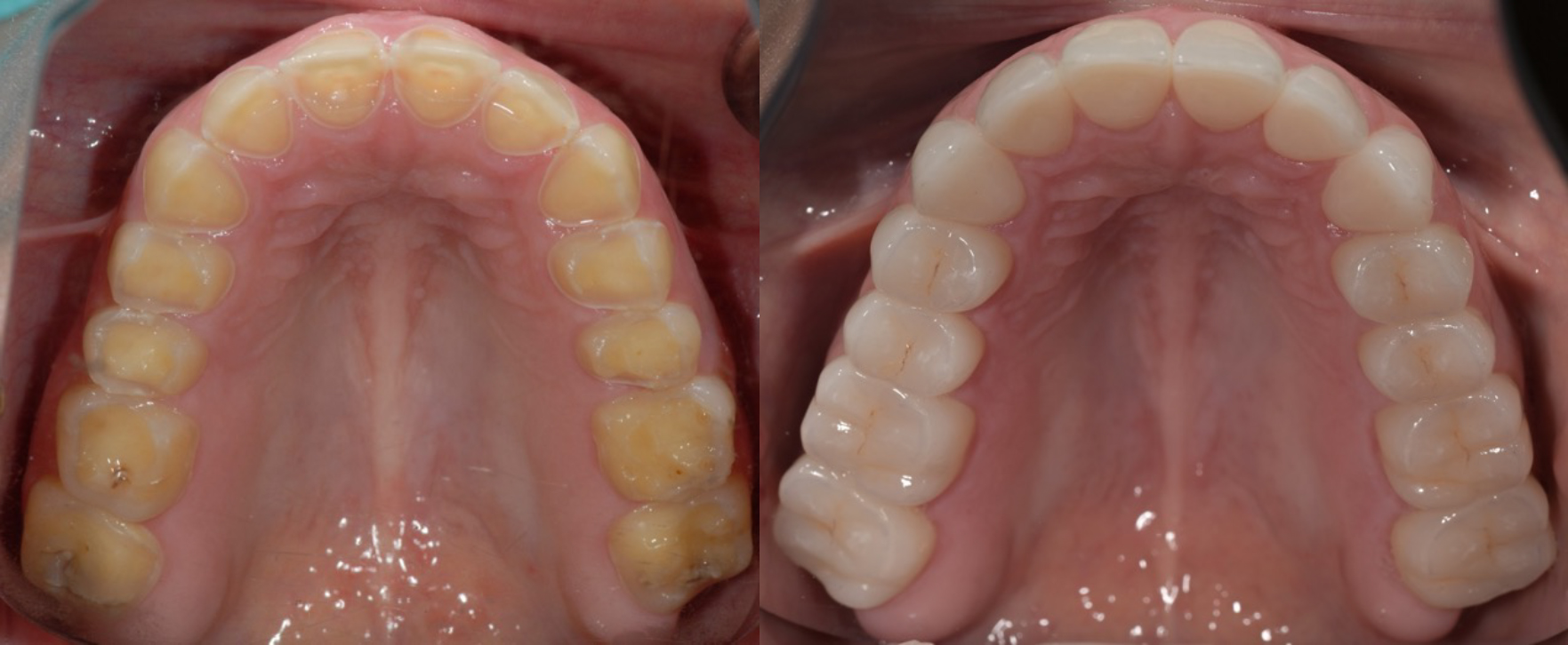 Occlusal_Gatta