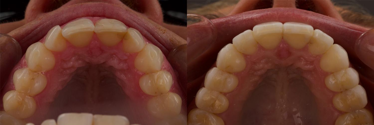 Occlusal_Hanson
