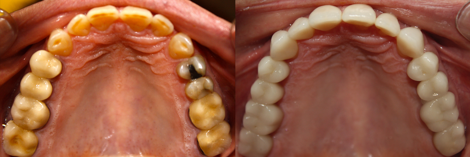Occlusal_Hillis
