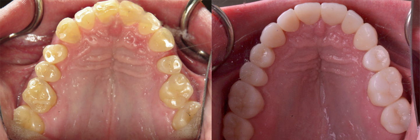 Occlusal_Kianimanesh