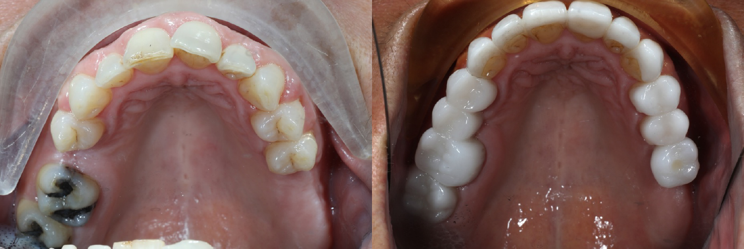 Occlusal_Klaich