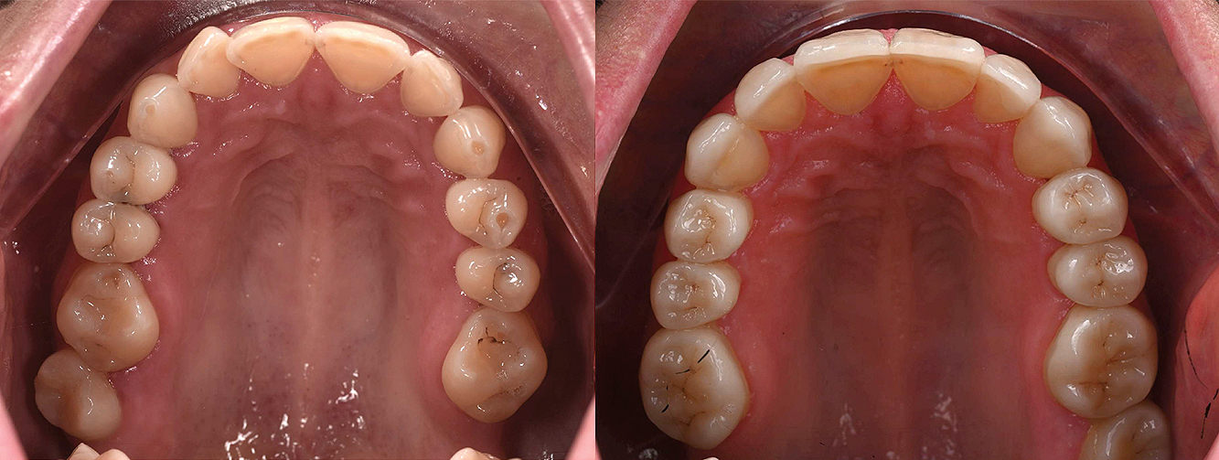 Occlusal_Leonhardt