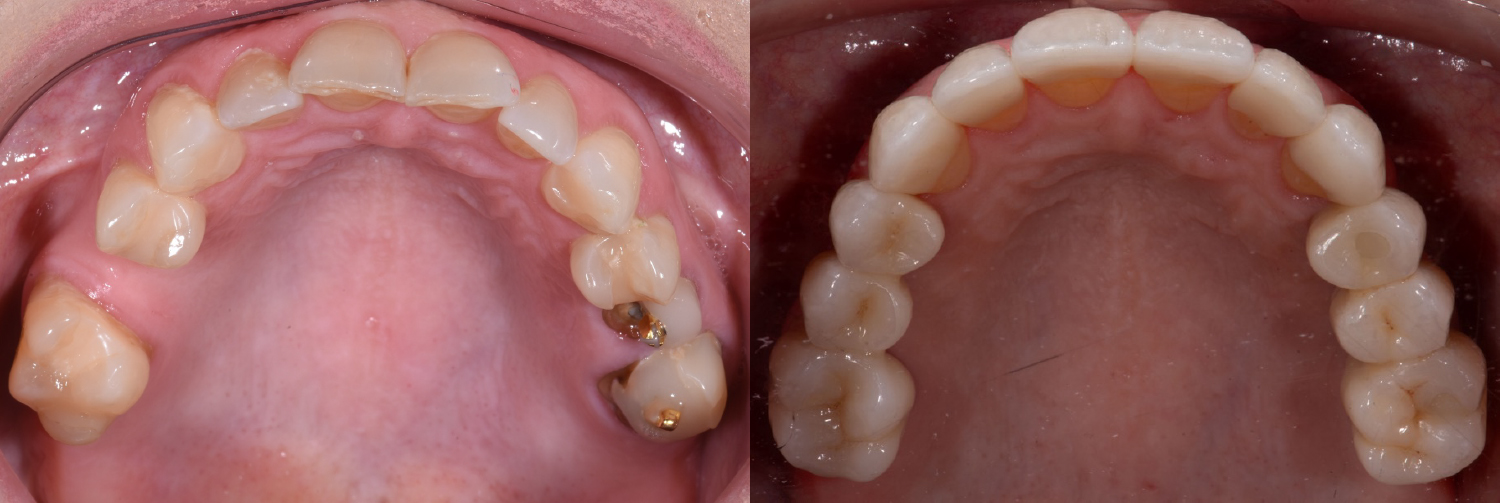 Occlusal_Lewis