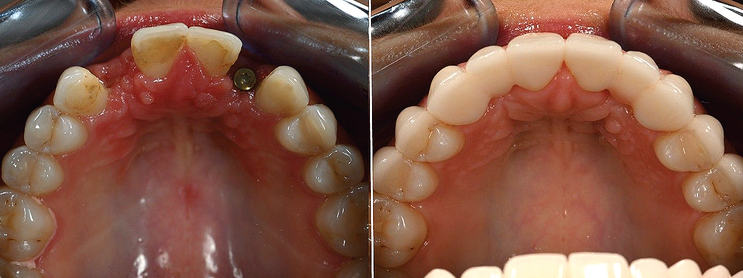 Occlusal_Miro