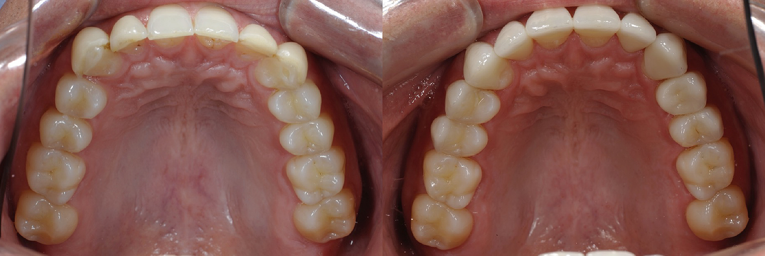 Occlusal_Rickert