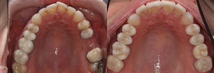 Occlusal_Sahasrabudhe