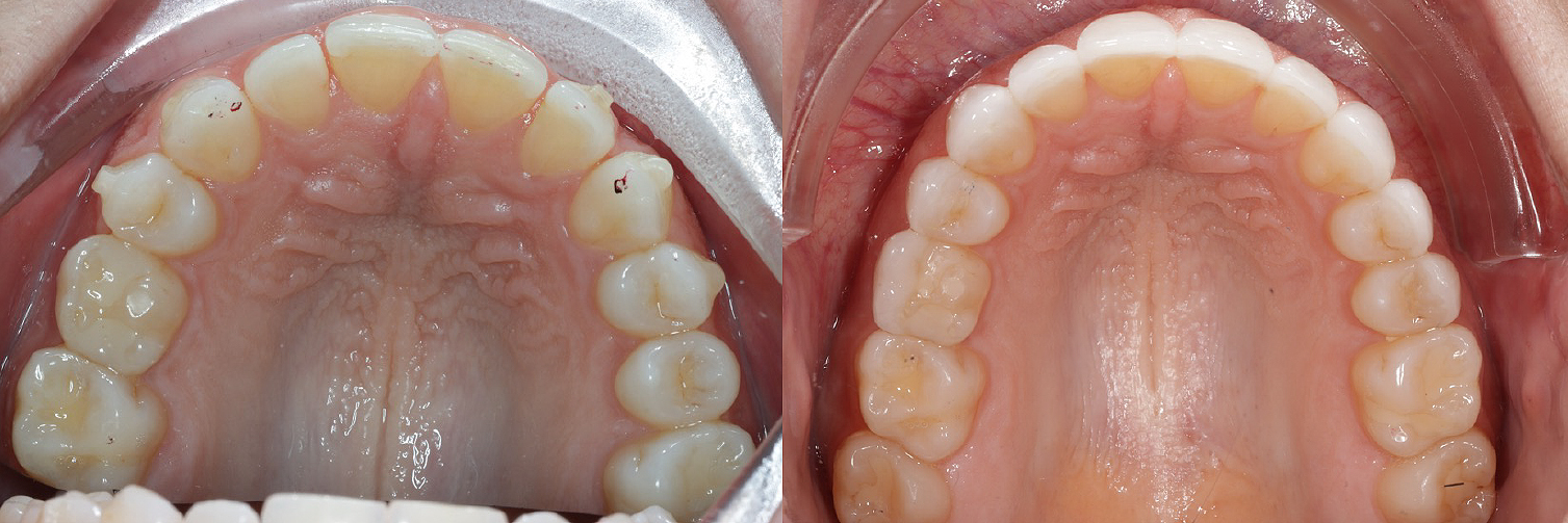 Occlusal_Schneider