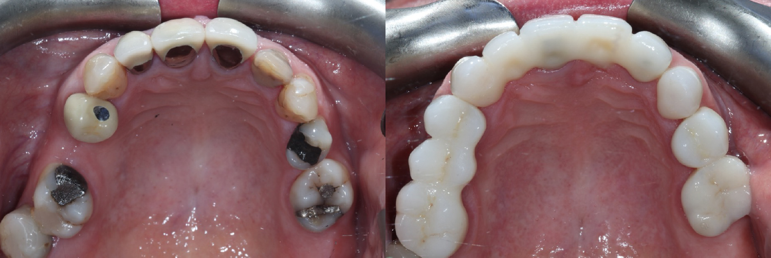 Occlusal_Sealey