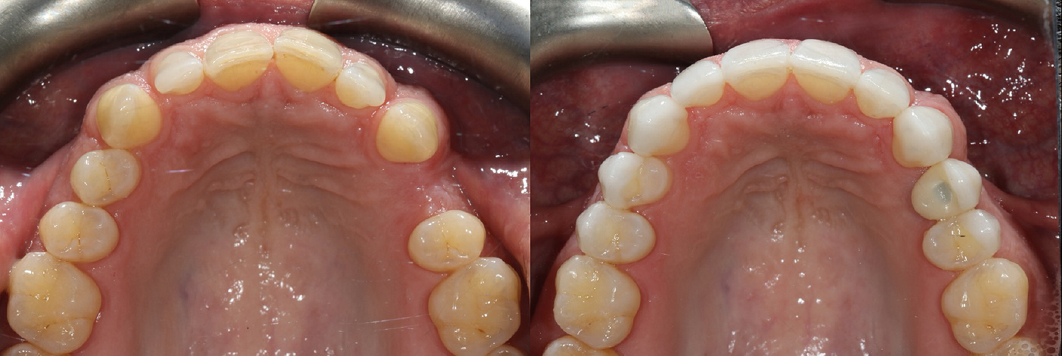 Occlusal_Sealey
