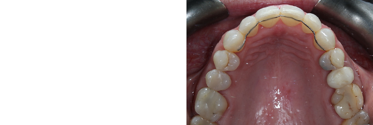 Occlusal_Sealey