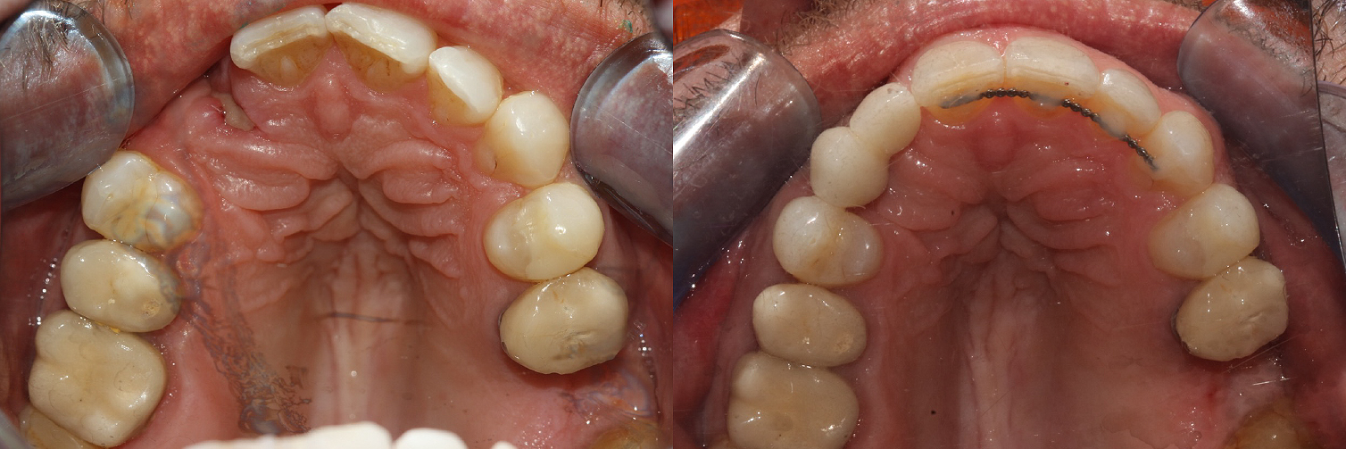 Occlusal_Simon