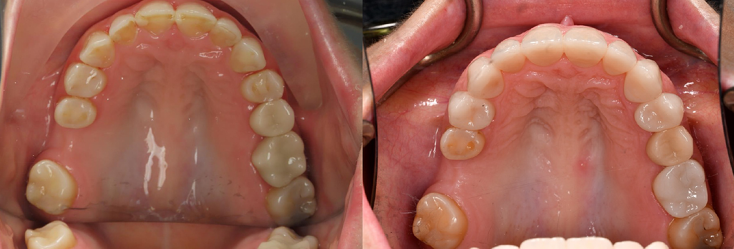 Occlusal_Wang