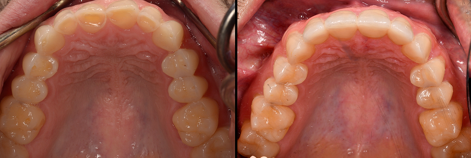 Occlusal_Wang