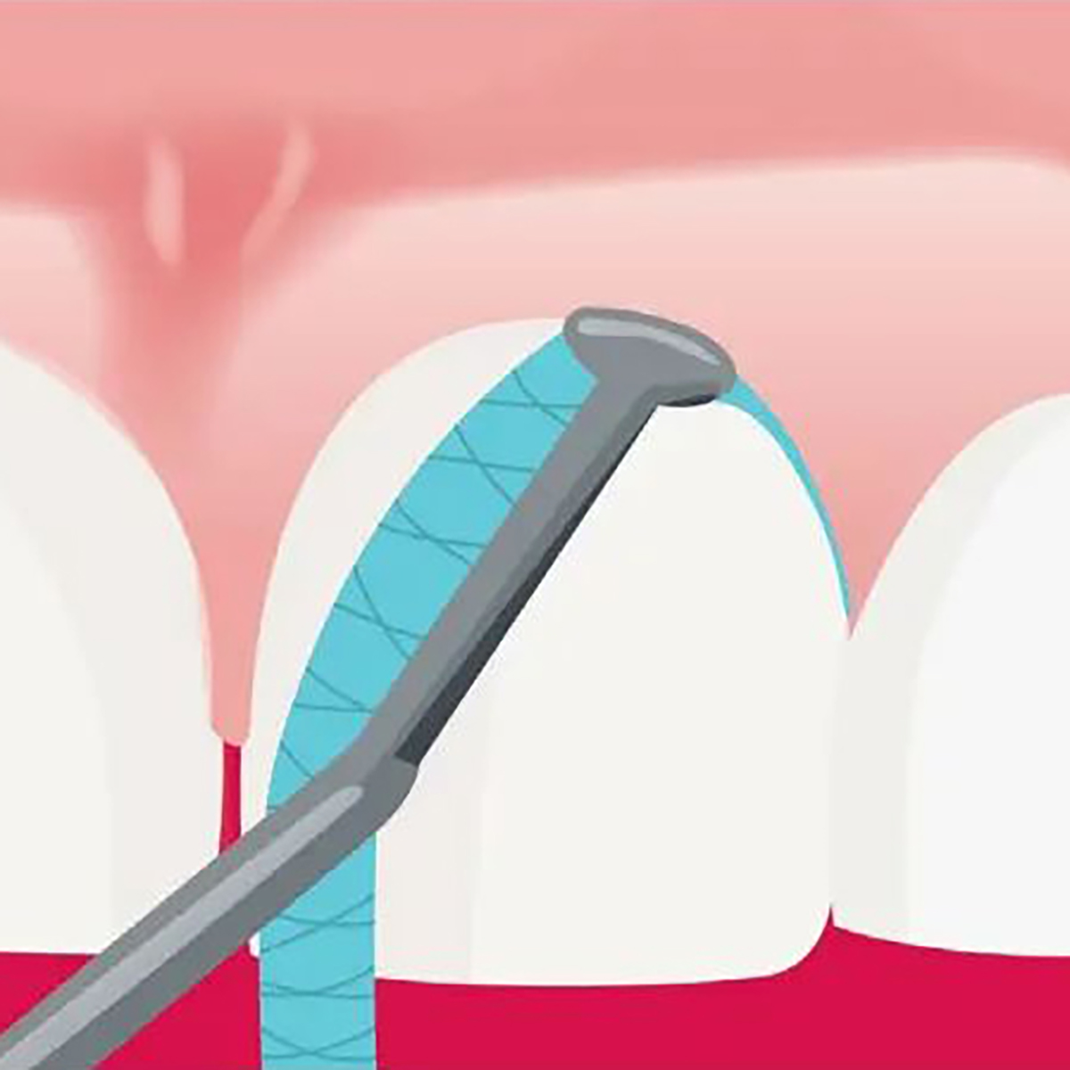 Intraoral Scanning And Treatment Quality: What Accuracy Studies Tell Us 