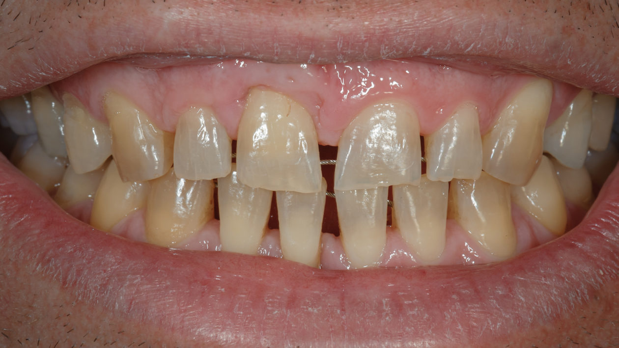 Post-orthodontic smile