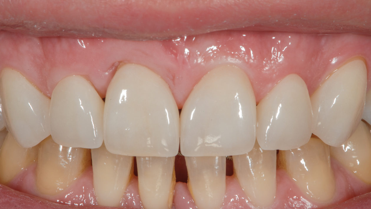 Teeth nos. 6-11 veneers