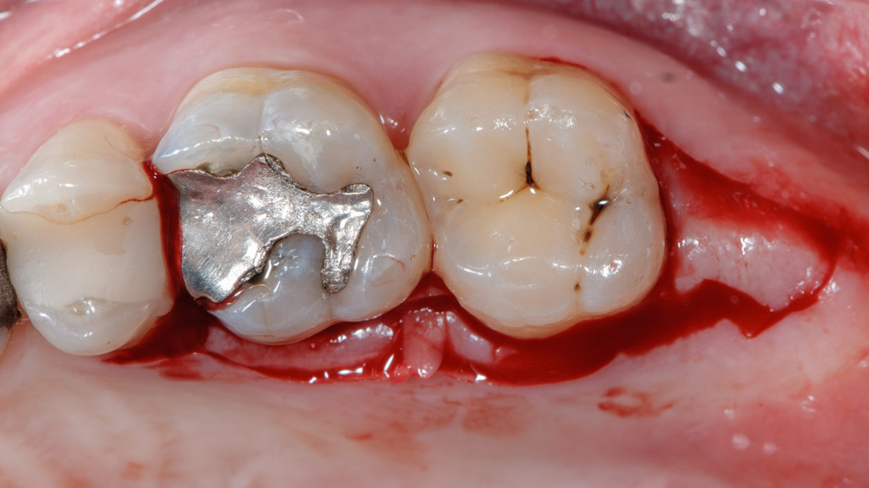Resective periodontal surgery