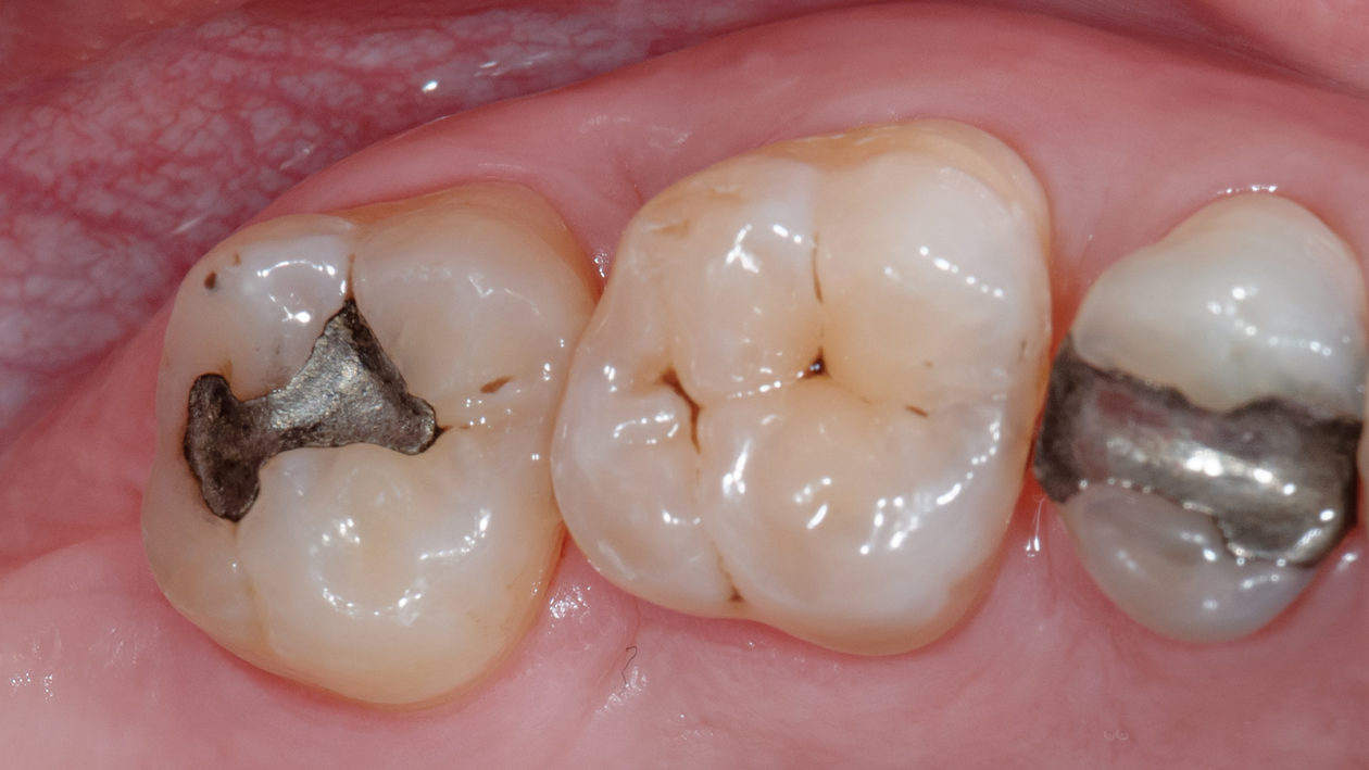 Resective periodontal surgery follow-up