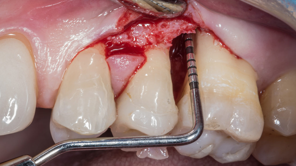 Regenerative periodontal surgery