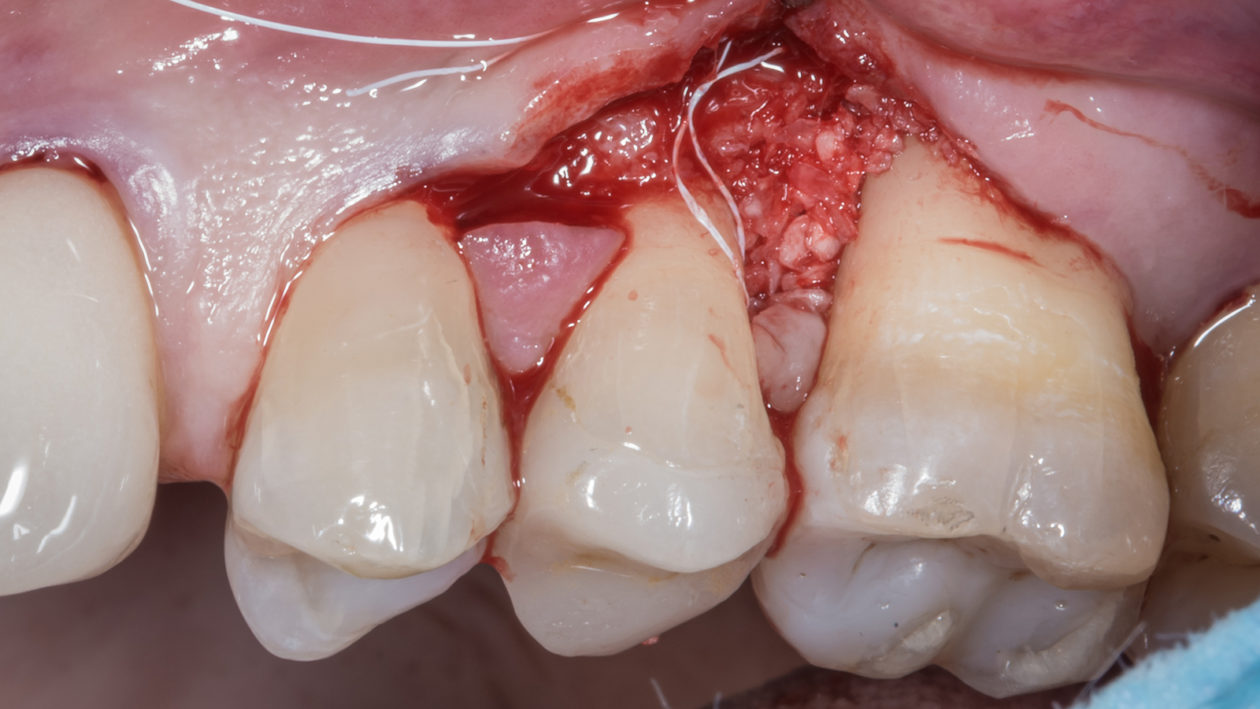 Regenerative periodontal surgery