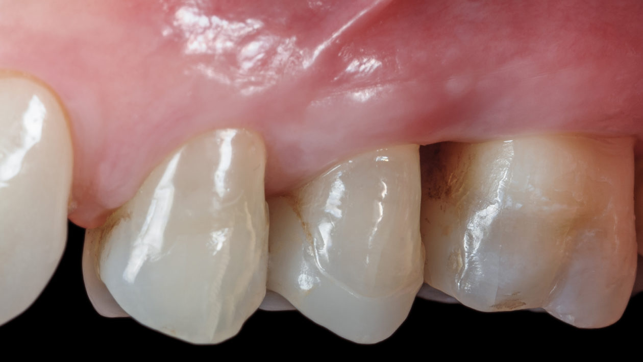 Regenerative periodontal surgery follow-up