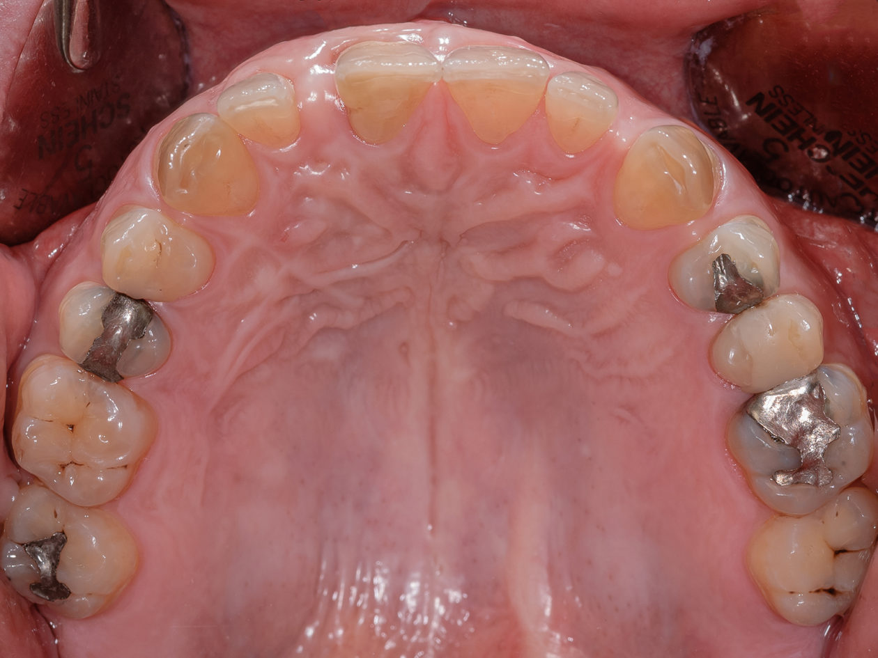 Initial maxillary occlusal view