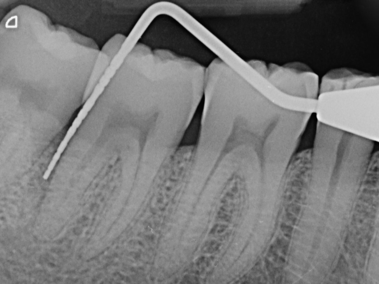 Tooth no. 31 radiograph