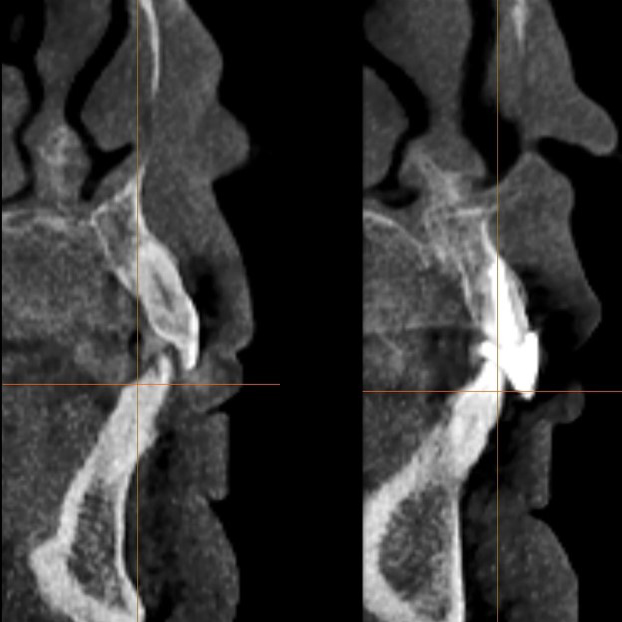 Initial sagittal CBCT images nos. 8 and 9