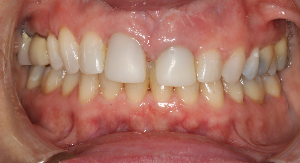 Restoration of maxillary centrals with provisional crowns of ideal width