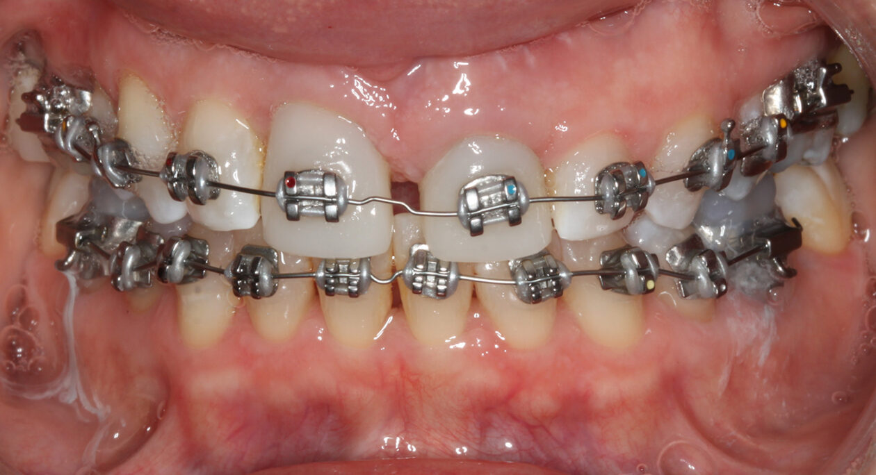 Placement of fixed orthodontic appliances