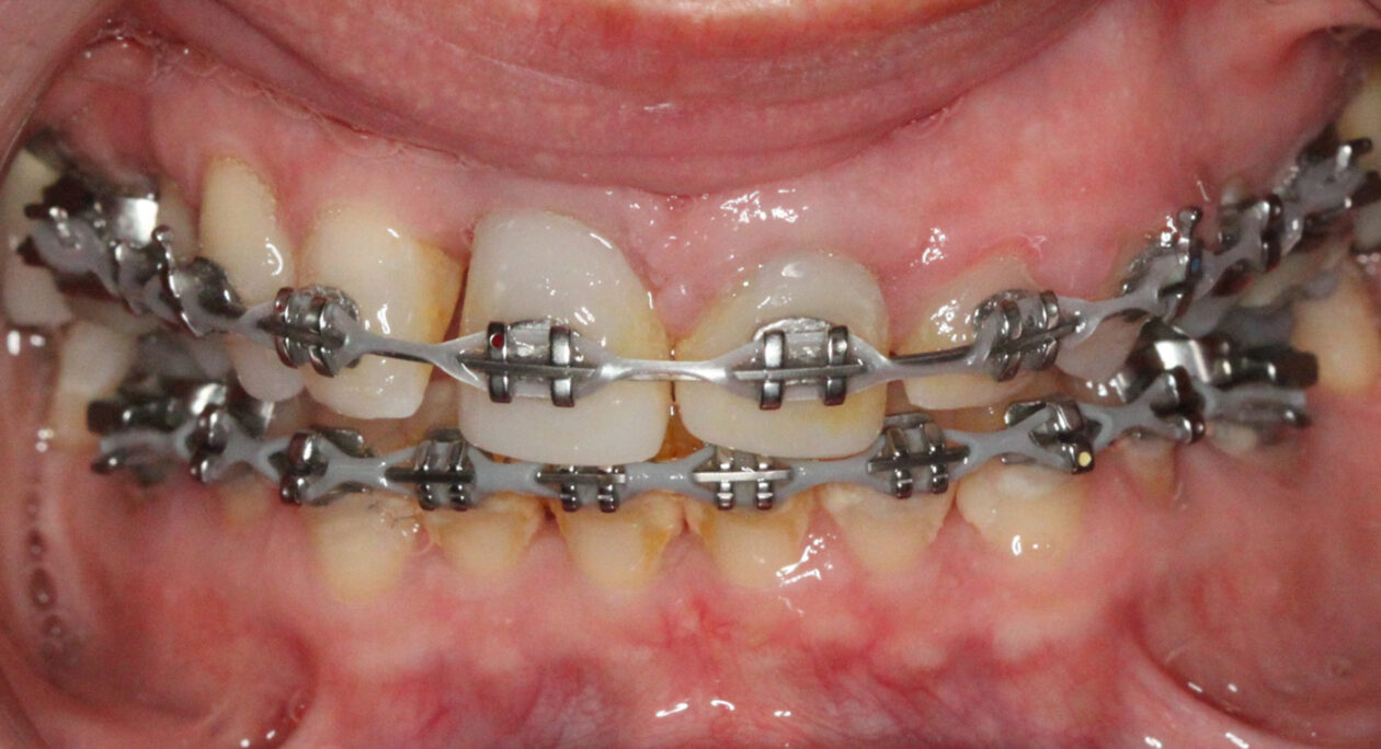 Orthodontic space closure