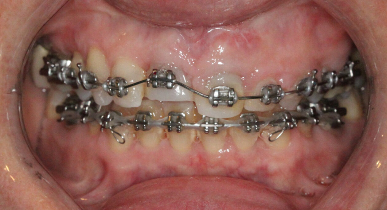 Reposition of bracket on no. 8 to allow for orthodontic extrusion