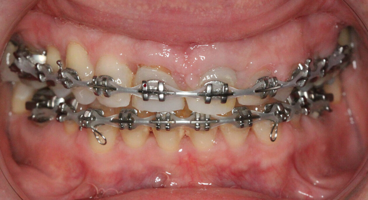 Orthodontic extrusion completed