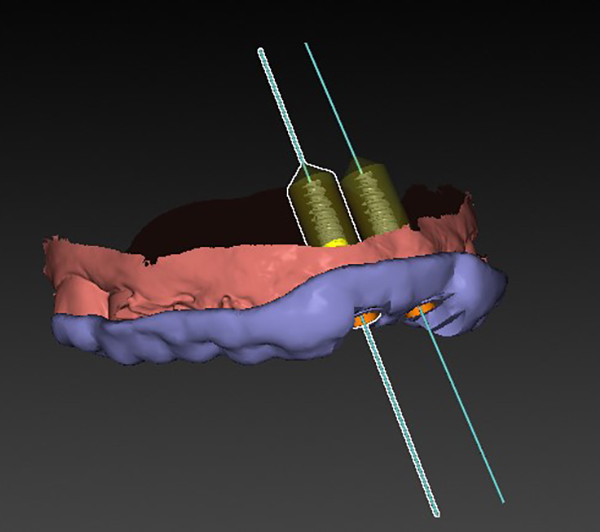 Digital treatment planning of implant stent – sagittal view