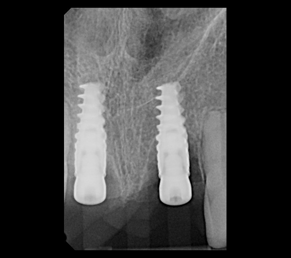 Periapical radiograph after implant placement