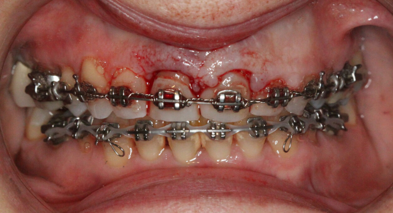 Placement of pontics using extracted teeth nos. 8 and 9 — maximum intercuspal position