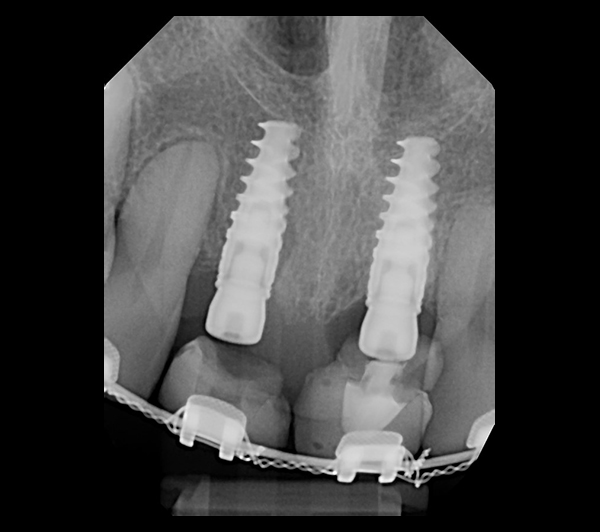 Periapical radiograph illustrating implants, healing caps, and pontics made with extracted teeth nos. 8 and 9