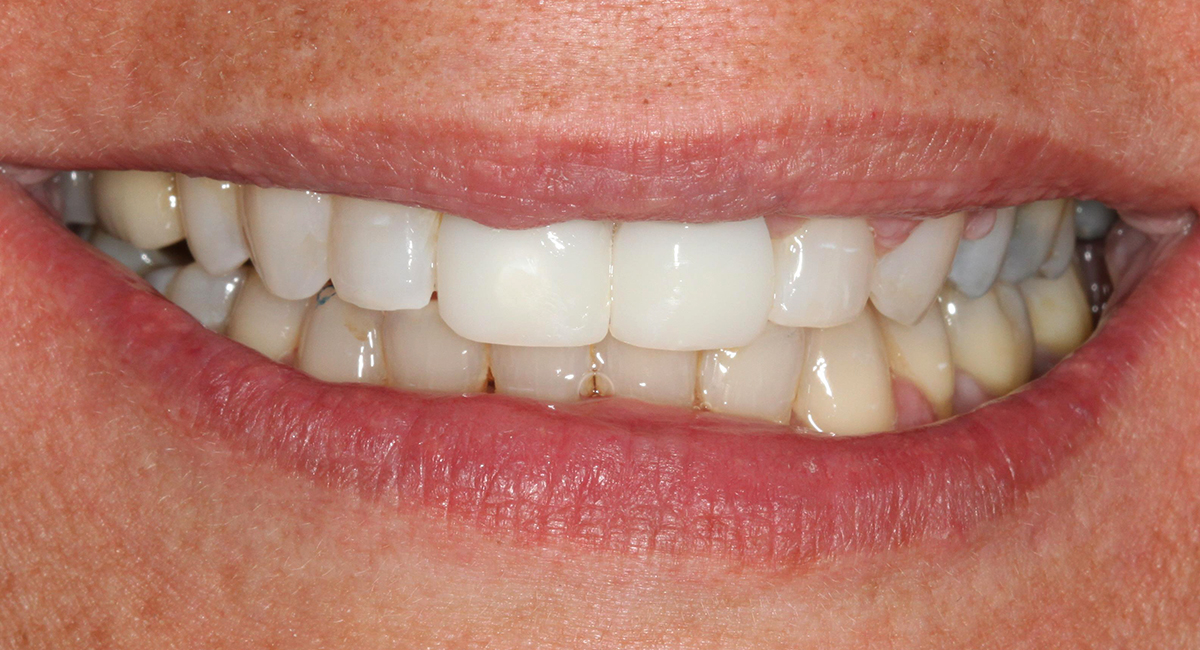 Provisional implant crowns nos. 8 and 9 – smile