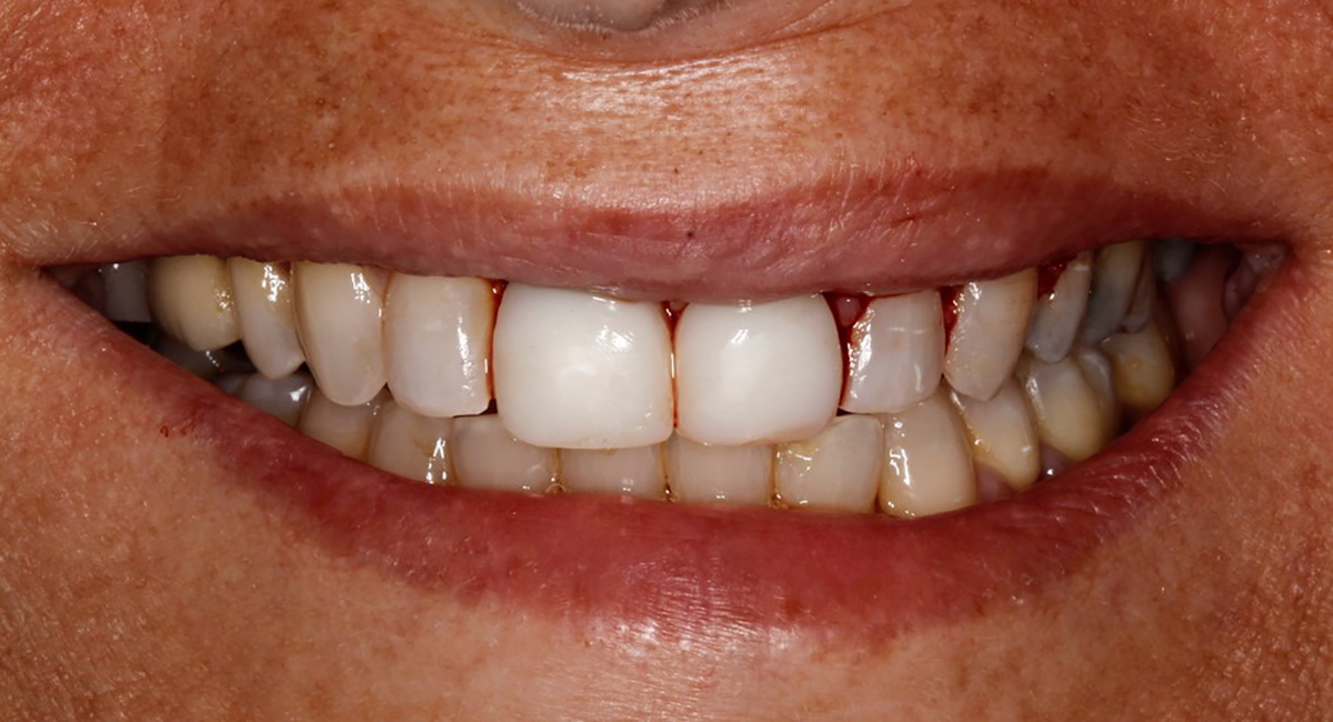 Esthetic crown lengthening nos. 10 and 11 – smile