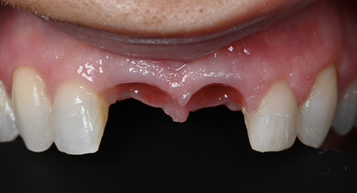 Gingival margins at intraoral scan for final implant crowns
